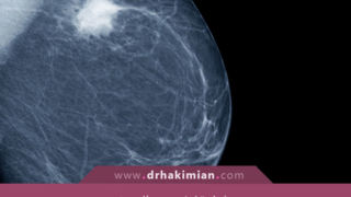شخیص زودهنگام سرطان سینه با هوش مصنوعی