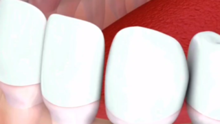 ایمپلنت های دندان جلو چه شکلی است