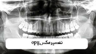 تفسیر عکس opg دندان