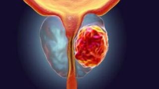 شایعترین علت مرگ مردان شایعترین علت مرگ مردان