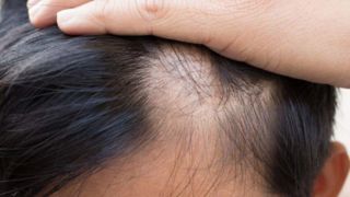 ۶ بیماری خودایمنی که باعث ریزش مو میشوند ۶ بیماری خودایمنی که باعث ریزش مو میشوند