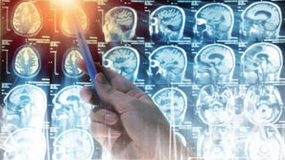 علائم هشدار دهنده تومور مغزی/ با مشاهده این علائم حتما به پزشک مراجعه کنید علائم هشدار دهنده تومور مغزی/ با مشاهده این علائم حتما به پزشک مراجعه کنید