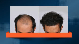 بدون کچل‌کردن و تراشیدن سر کاشت کنید