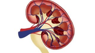 علائم، درمان و باورهای غلط درباره سنگ کلیه