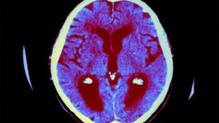 فراموشی زودهنگام در کودکان؛ پای سرب در میان است  