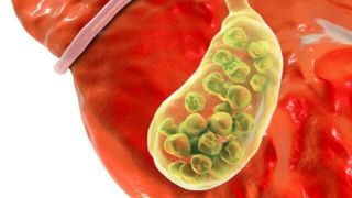 رفع خطر سنگ کیسه صفرا با مصرف آنتی‌اکسیدان‌ها