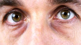 «چشم راکونی» یا تیرگی زیر چشم چیست و چگونه آن را برطرف کنیم؟ «چشم راکونی» یا تیرگی زیر چشم چیست و چگونه آن را برطرف کنیم؟