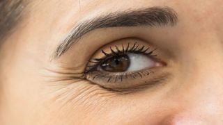 درمان خطوط پنجه کلاغی اطراف چشم