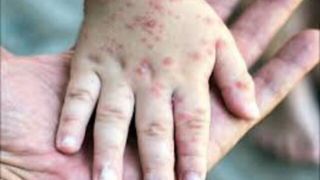 لزوم ایمنی مادران باردار در برابر آبله‌مرغان / اهمیت واکسیناسیون قبل از بارداری