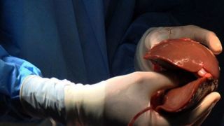 این خوراکی‌ها کبدتان را چرب می‌کند/ کبد چرب جای هپاتیت B را در فهرست انتظار پیوند گرفت