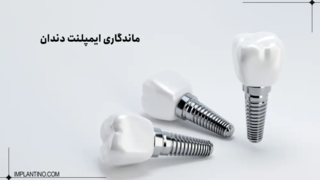 چگونه می توان ماندگاری ایمپلنت دندان را افزایش داد؟