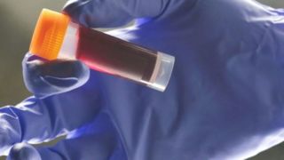 ارتباط این گروه خونی و سکته زودهنگام