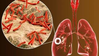 شناسایی ۶۵۶۵ مبتلا به "سل" در کشور/ تشخیص و درمان بیماری در مراکز بهداشتی رایگان است