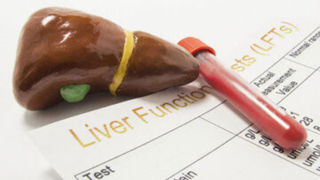 علت بالا رفتن آنزیمهای کبدی چیست؟/ باید مراقب چه علائمی باشیم علت بالا رفتن آنزیمهای کبدی چیست؟/ باید مراقب چه علائمی باشیم