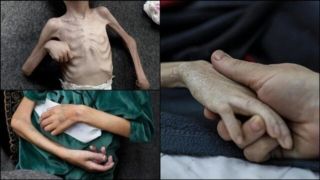 سوء تغذیه در غزه از ۹۰ درصد فراتر رفته است  