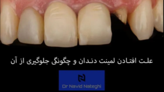 دلایل افتادن لمینت دندان و راهکارهای جلوگیری از آن از زبان دکتر ناطقی دلایل افتادن لمینت دندان و راهکارهای جلوگیری از آن از زبان دکتر ناطقی