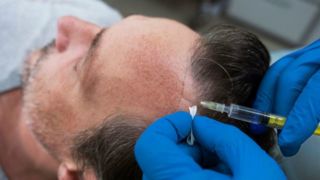 پیشرفته ترین روش کاشت مو کدام است؟