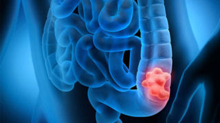 چطور جلوی سرطان روده را بگیریم؟ چطور جلوی سرطان روده را بگیریم؟