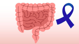 سرطان کولورکتال چیست و چه علائمی دارد؟