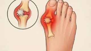 نقرس چیست و درمان اصولی آن چگونه است؟  