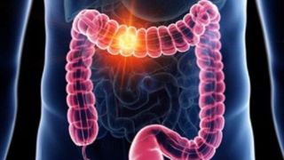 چرایی بروز سرطان روده بزرگ و علائم ابتلا به آن 