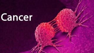۳۰ تا ۵۰ درصد سرطان‌ها قابل پیشگیری است 
