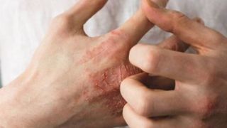 توصیه‌هایی درباره یک عارضه پوستیِ شایع