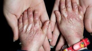 ۲۵ بیماری جدید به فهرست بیماری‌های نادر کشور اضافه شد